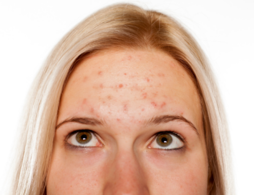 How to Treat Acne without Antibiotics