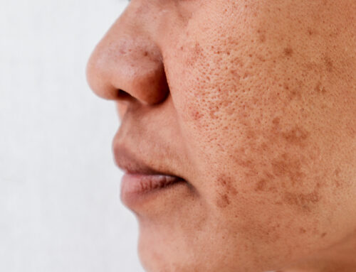 Why You Should Not Get Laser Treatments for Melasma